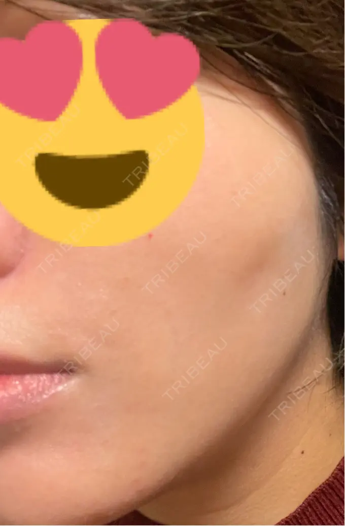 糸リフト 東京シンデレラ美容外科 池袋院 DAY 12 メイン用