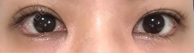 目尻切開 / タレ目形成・グラマラスライン（埋没） LOUIS CLINIC 二子玉川院【ルイクリニック】 DAY 12 メイン用