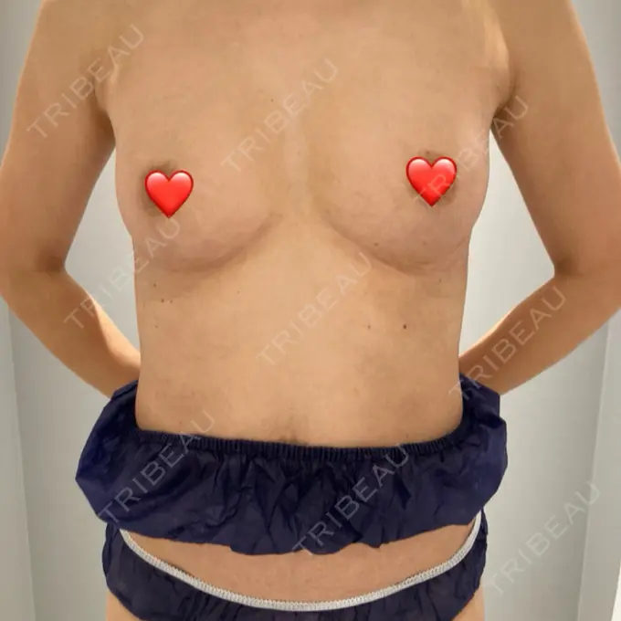 脂肪吸引（脚） / 豊胸（脂肪注入） Mods Clinic（モッズクリニック） 名古屋院 AFTER メイン用