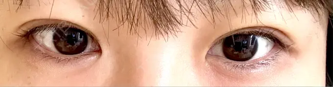 二重埋没 / 自然癒着法 Brandnew Beauty Clinic DAY 3 メイン用