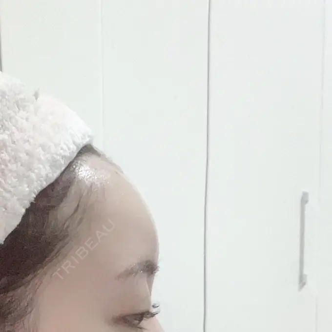 ヒアルロン酸注入（額） / ヒアルロン酸注入（こめかみ） / ボトックス（額） LA CLEF CLINIC（ラクレクリニック） DAY 1 メイン用