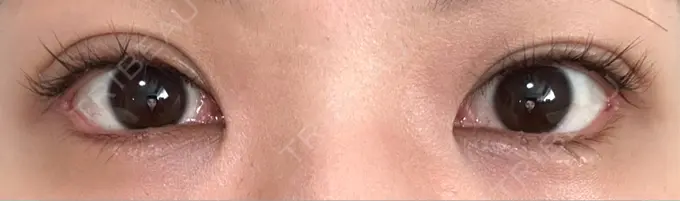 目尻切開 / タレ目形成・グラマラスライン（埋没） LOUIS CLINIC 二子玉川院【ルイクリニック】 DAY 13 メイン用