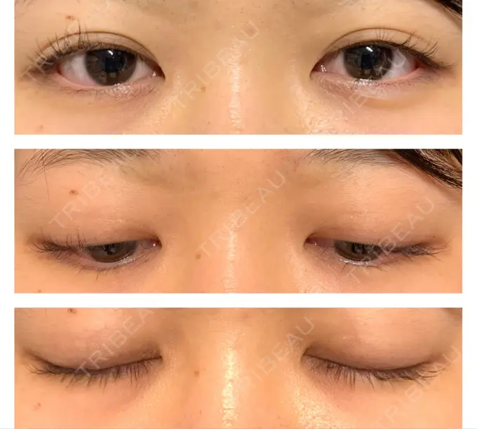 二重埋没 水の森美容クリニック 東京銀座院 DAY 365 メイン用