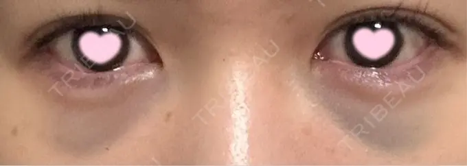 クマ治療 / 肌ヒアルロン酸注入（たるみ・シワ改善） / ヒアルロン酸注入（目の下） 東京シンデレラ美容外科 池袋院 DAY 0 メイン用