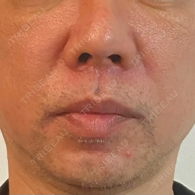 ピコレーザートーニング（美白・肝斑） ルラ美容クリニック 横浜院 DAY 8 メイン用