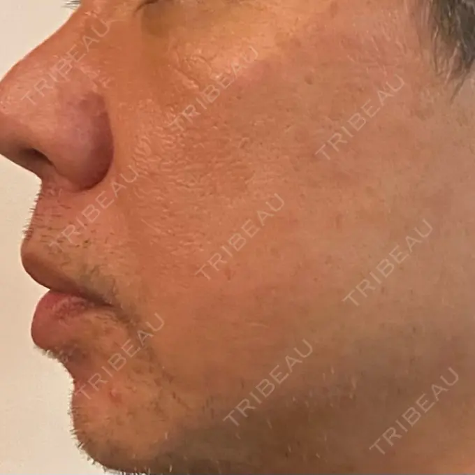 ピコレーザートーニング（美白・肝斑） ルラ美容クリニック 横浜院 DAY 8 メイン用