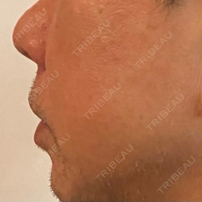 ピコレーザートーニング（美白・肝斑） ルラ美容クリニック 横浜院 DAY 8 メイン用