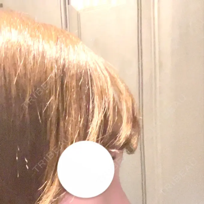 ヒアルロン酸注入（額） / ヒアルロン酸注入（こめかみ） / ボトックス（額） LA CLEF CLINIC（ラクレクリニック） DAY 2 メイン用