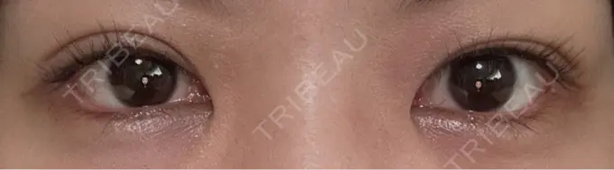 目尻切開 / タレ目形成・グラマラスライン（埋没） LOUIS CLINIC 二子玉川院【ルイクリニック】 DAY 14 メイン用