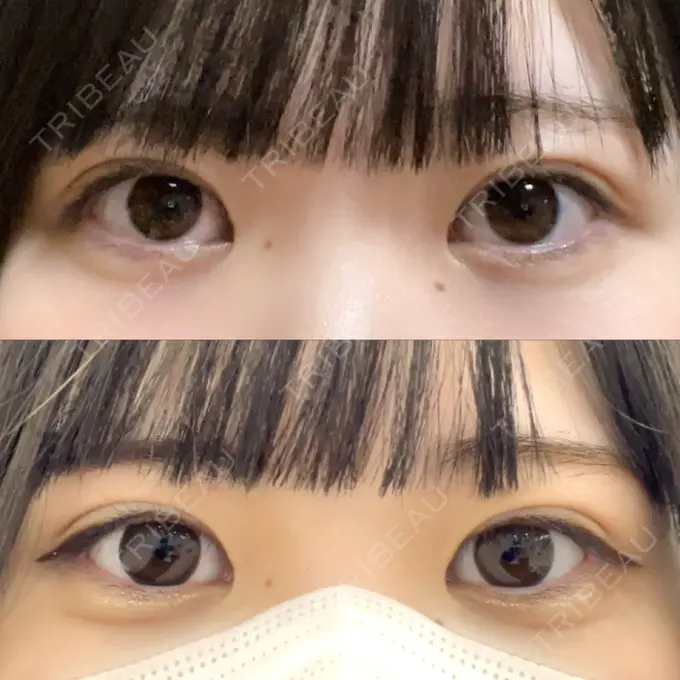 二重埋没 / 目頭切開 東京シンデレラ美容外科 池袋院 AFTER メイン用