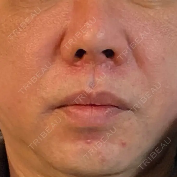 ピコレーザートーニング（美白・肝斑） ルラ美容クリニック 横浜院 DAY 9 メイン用