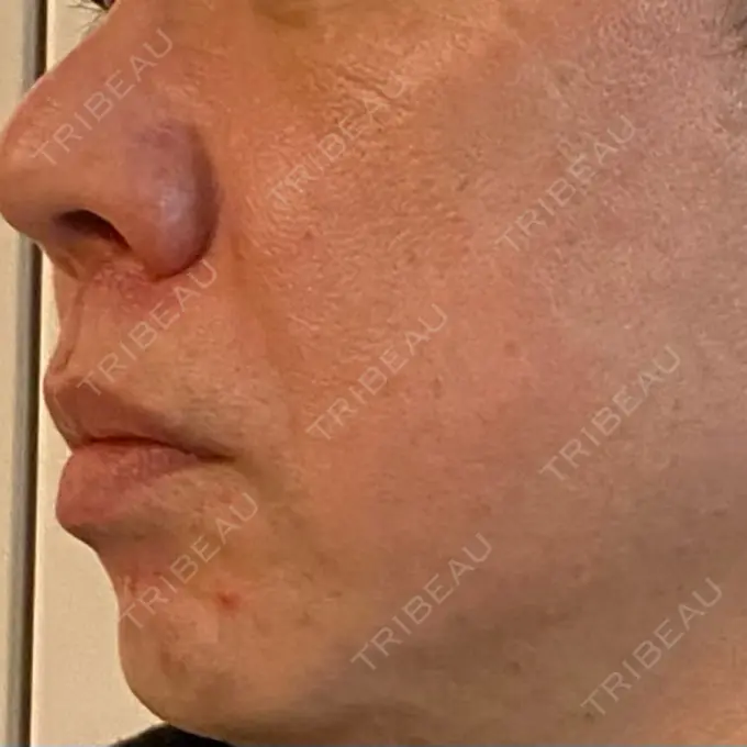 ピコレーザートーニング（美白・肝斑） ルラ美容クリニック 横浜院 DAY 9 メイン用