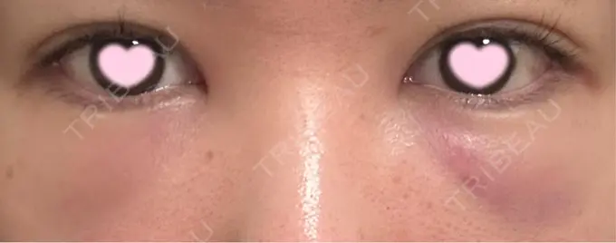 クマ治療 / 肌ヒアルロン酸注入（たるみ・シワ改善） / ヒアルロン酸注入（目の下） 東京シンデレラ美容外科 池袋院 DAY 1 メイン用