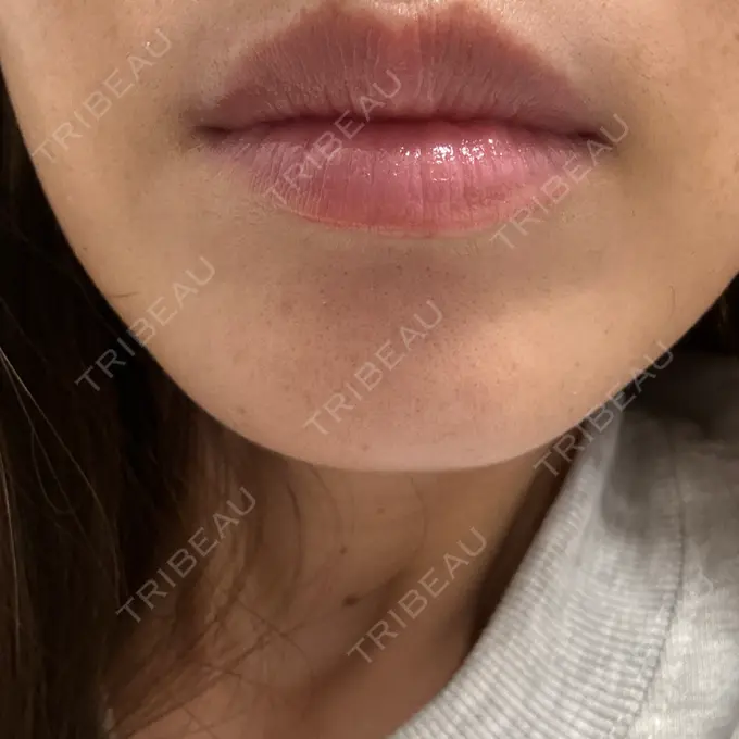 医療脱毛（顔） 共立美容外科 熊本院 AFTER メイン用