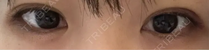 二重埋没 / 自然癒着法 Brandnew Beauty Clinic DAY 6 メイン用