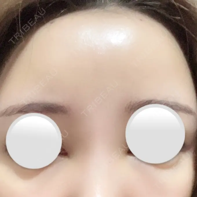 ヒアルロン酸注入（額） / ヒアルロン酸注入（こめかみ） / ボトックス（額） LA CLEF CLINIC（ラクレクリニック） DAY 3 メイン用