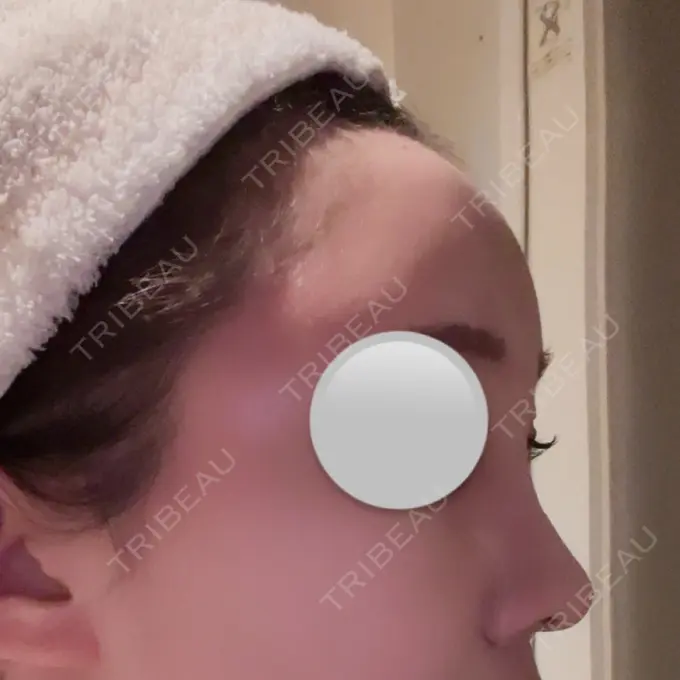 ヒアルロン酸注入（額） / ヒアルロン酸注入（こめかみ） / ボトックス（額） LA CLEF CLINIC（ラクレクリニック） DAY 3 メイン用