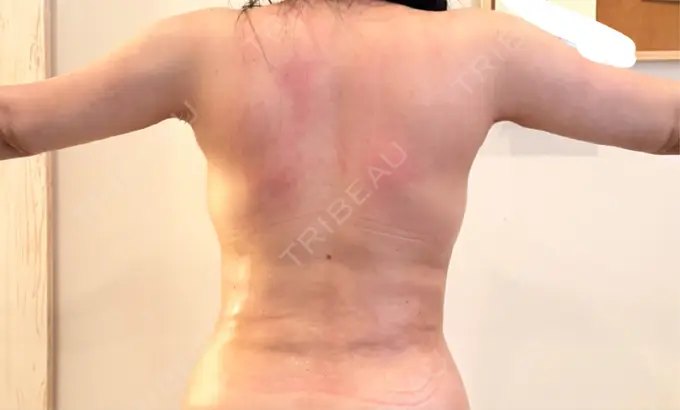 脂肪吸引（二の腕） / 脂肪吸引（お腹） / 豊胸（脂肪注入） / 脂肪注入（額） / 脂肪吸引（腰） ICON CLINIC DAY 31 メイン用