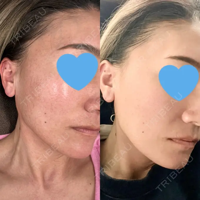 ボトックス（エラ・小顔） / ハイフ（顔） TCB東京中央美容外科 横浜駅前院 DAY 8 メイン用