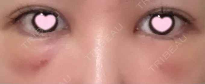 クマ治療 / 肌ヒアルロン酸注入（たるみ・シワ改善） / ヒアルロン酸注入（目の下） 東京シンデレラ美容外科 池袋院 DAY 2 メイン用