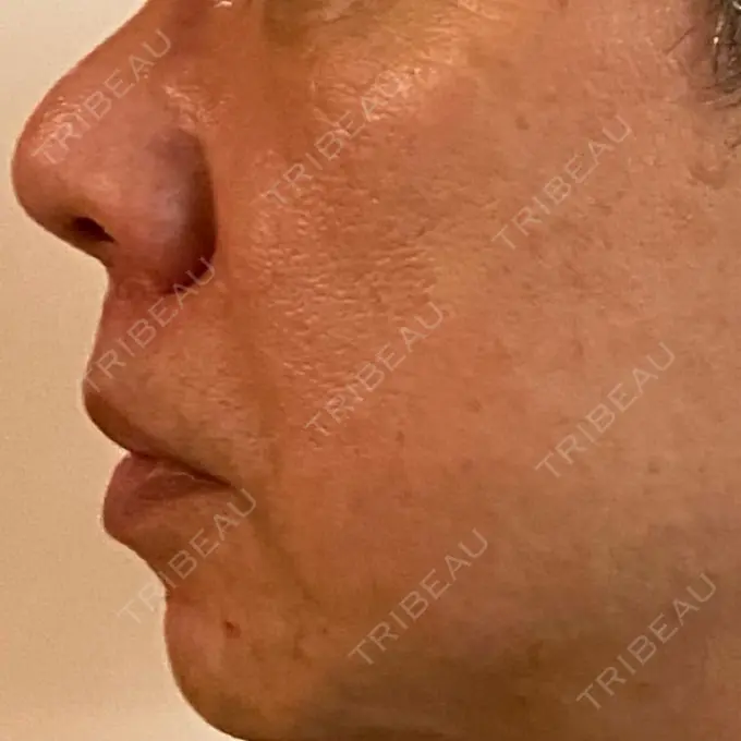 ピコレーザートーニング（美白・肝斑） ルラ美容クリニック 横浜院 DAY 10 メイン用