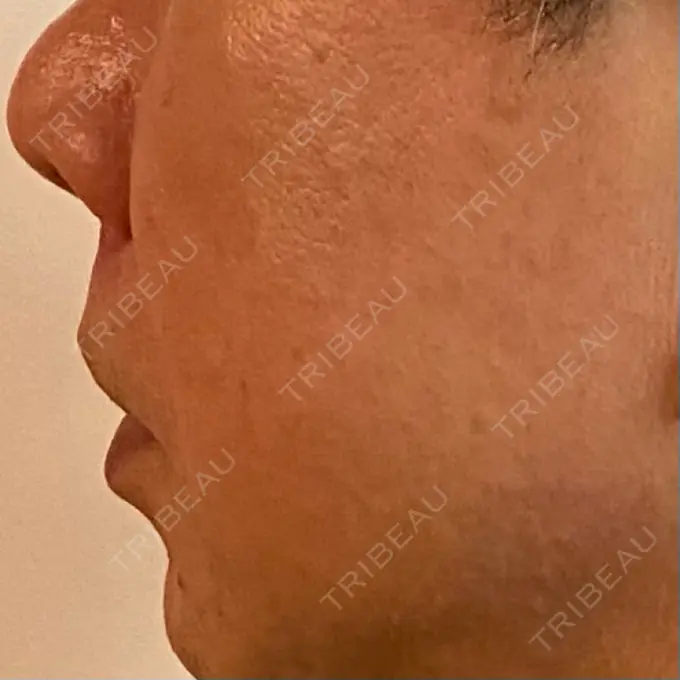 ピコレーザートーニング（美白・肝斑） ルラ美容クリニック 横浜院 DAY 10 メイン用