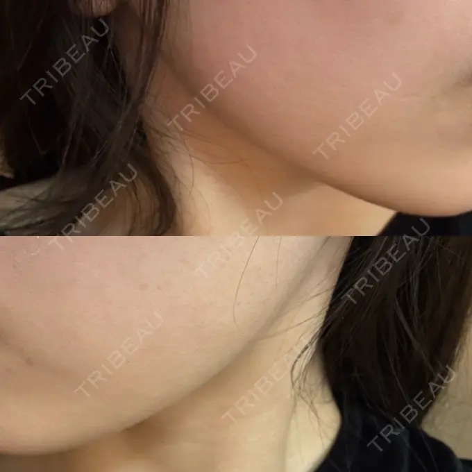 ハイフ（顔） しんゆり美容健康クリニック DAY 0 メイン用