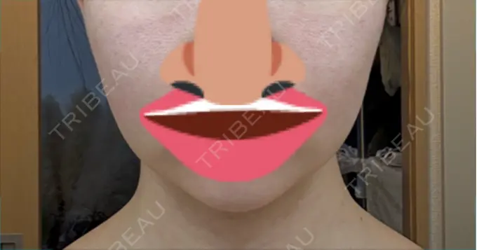 ヒアルロン酸注入（頬） ルラ美容クリニック 福岡本院 DAY 3 メイン用