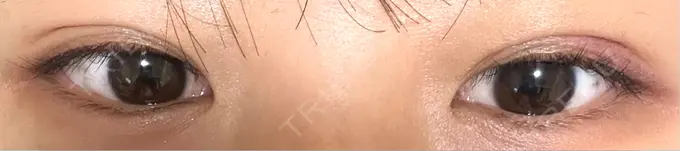 二重埋没 / 自然癒着法 Brandnew Beauty Clinic DAY 7 メイン用