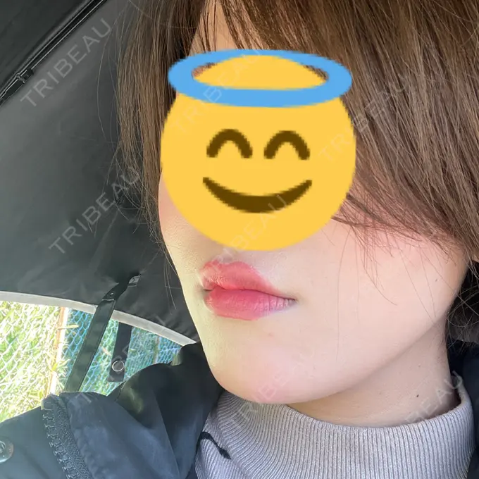 糸リフト 東京シンデレラ美容外科 池袋院 DAY 17 メイン用