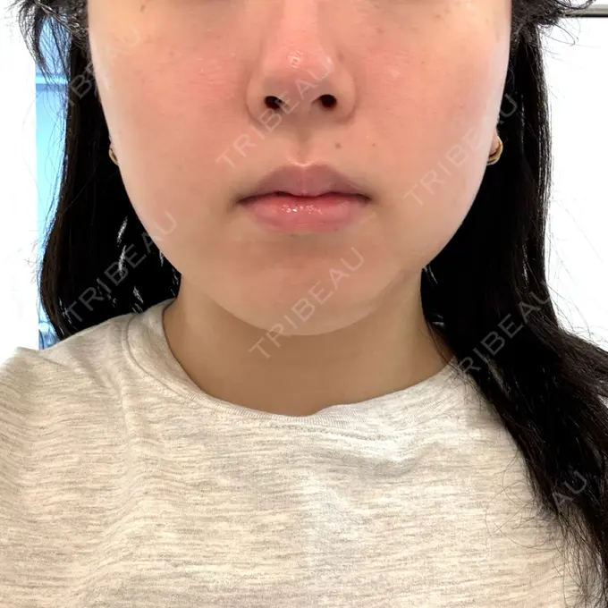 ハイフ（顔） しんゆり美容健康クリニック DAY 0 メイン用