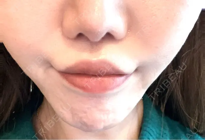 人中短縮 / 口角挙上 Otus Clinic 【オータスクリニック】 DAY 113 メイン用