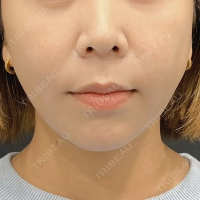 糸リフト / 脂肪吸引注射（顔） 湘南美容クリニック 吉祥寺院 AFTER メイン用