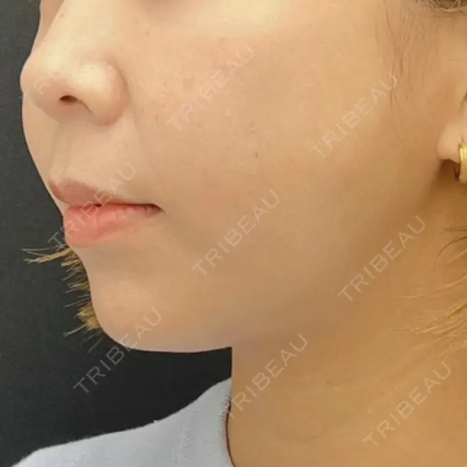 糸リフト / 脂肪吸引注射（顔） 湘南美容クリニック 吉祥寺院 DAY 9 メイン用