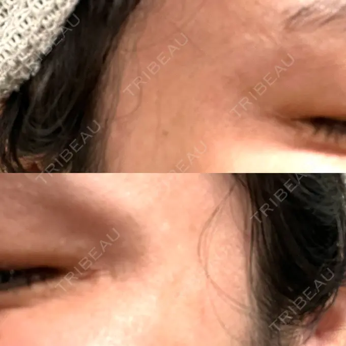 ボトックス（目尻） 湘南美容クリニック 立川院 DAY 9 メイン用