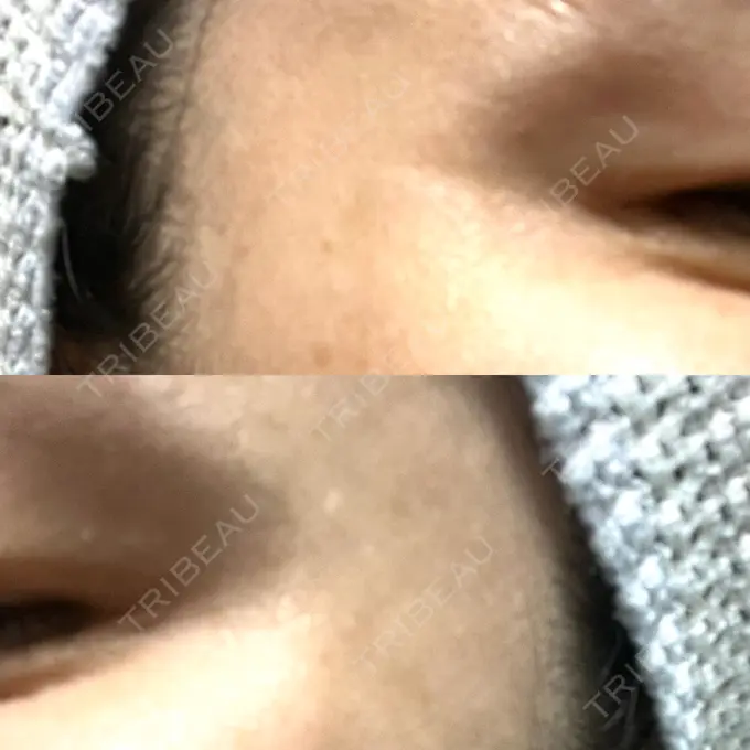 ボトックス（目尻） 湘南美容クリニック 立川院 DAY 7 メイン用