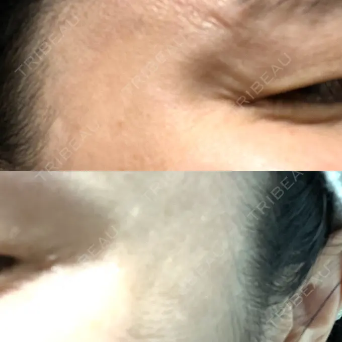 ボトックス（目尻） 湘南美容クリニック 立川院 DAY 5 メイン用