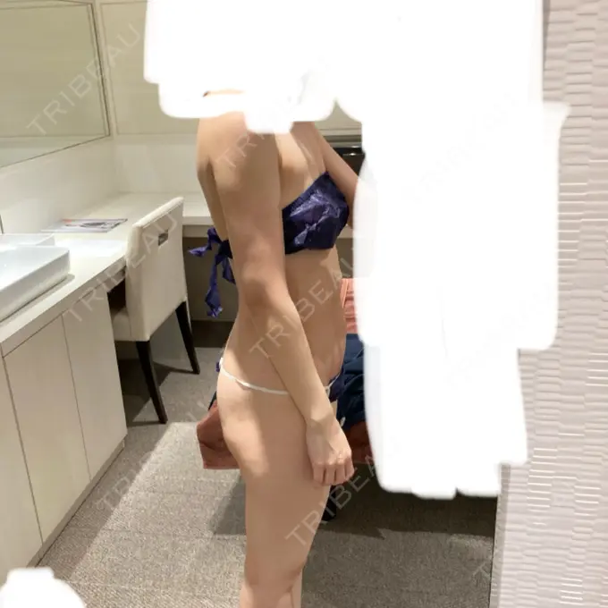 脂肪吸引（顔） / 脂肪吸引（二の腕） / 医療痩身（お腹） / 脂肪吸引（腰） / 脂肪吸引（肩） Mods Clinic（モッズクリニック） 福岡院 DAY 21 メイン用