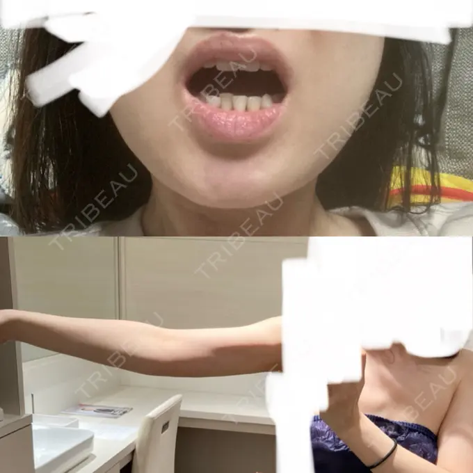 脂肪吸引（顔） / 脂肪吸引（二の腕） / 医療痩身（お腹） / 脂肪吸引（腰） / 脂肪吸引（肩） Mods Clinic（モッズクリニック） 福岡院 DAY 21 メイン用