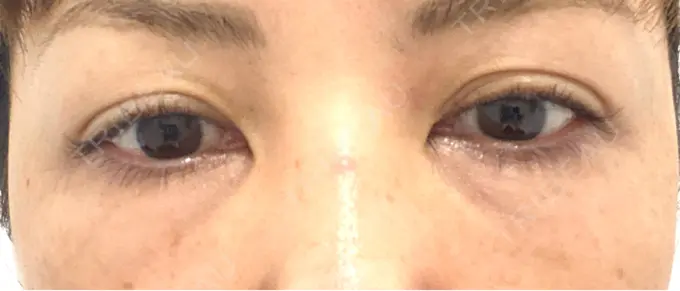 クマ治療 / 下まぶたたるみ取り / ヒアルロン酸注入（目の下） / ボトックス（目尻） TCB東京中央美容外科 神戸院 DAY 50 メイン用