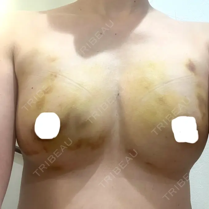 豊胸（脂肪注入） Mods Clinic（モッズクリニック） 名古屋院 DAY 74 メイン用