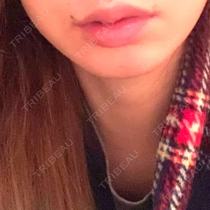 ハイフ（顔） AZ BEAUTY CLINIC AFTER メイン用