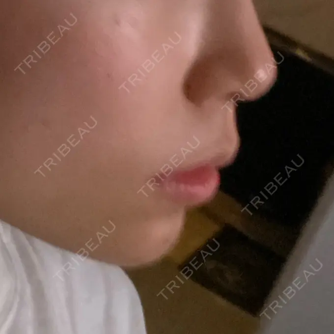 ボトックス（あご） / ヒアルロン酸注入（あご） / ボトックス（エラ・小顔） / ボトックス（肩） 仙台TAクリニック AFTER メイン用