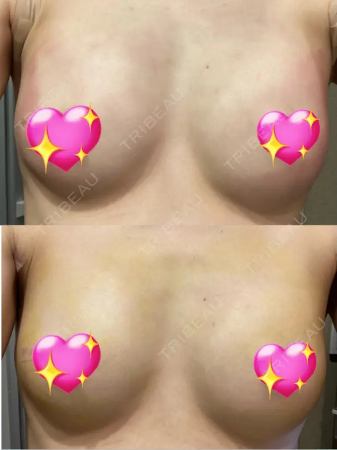 豊胸（脂肪注入） 銀座マイアミ美容外科 DAY 6 メイン用