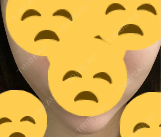 糸リフト / 脂肪吸引（顔） / 下まぶたの脂肪取り / 脂肪注入（目の下） 東京ココセランクリニック DAY 35 メイン用