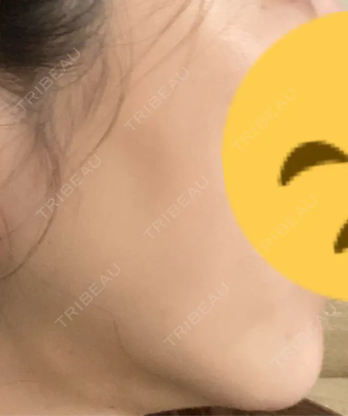 糸リフト / 脂肪吸引（顔） / 下まぶたの脂肪取り / 脂肪注入（目の下） 東京ココセランクリニック DAY 35 メイン用