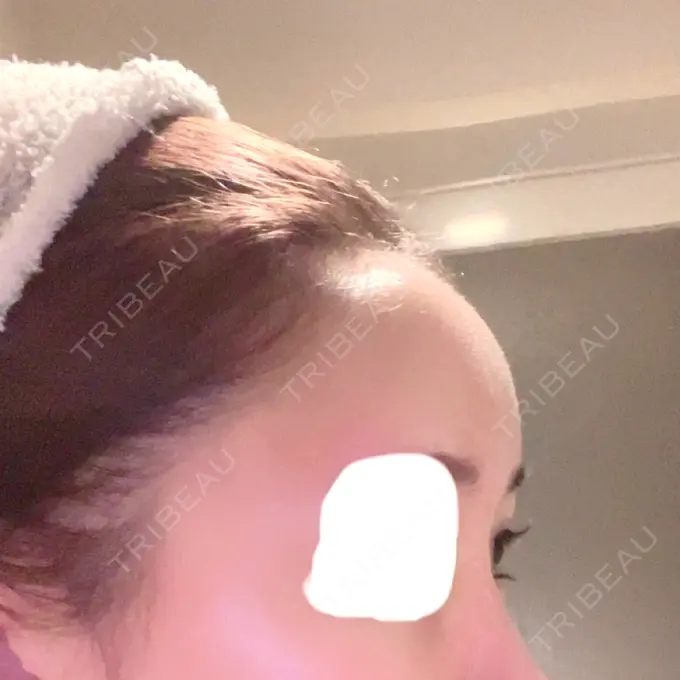 ヒアルロン酸注入（額） / ヒアルロン酸注入（こめかみ） / ボトックス（額） LA CLEF CLINIC（ラクレクリニック） DAY 6 メイン用