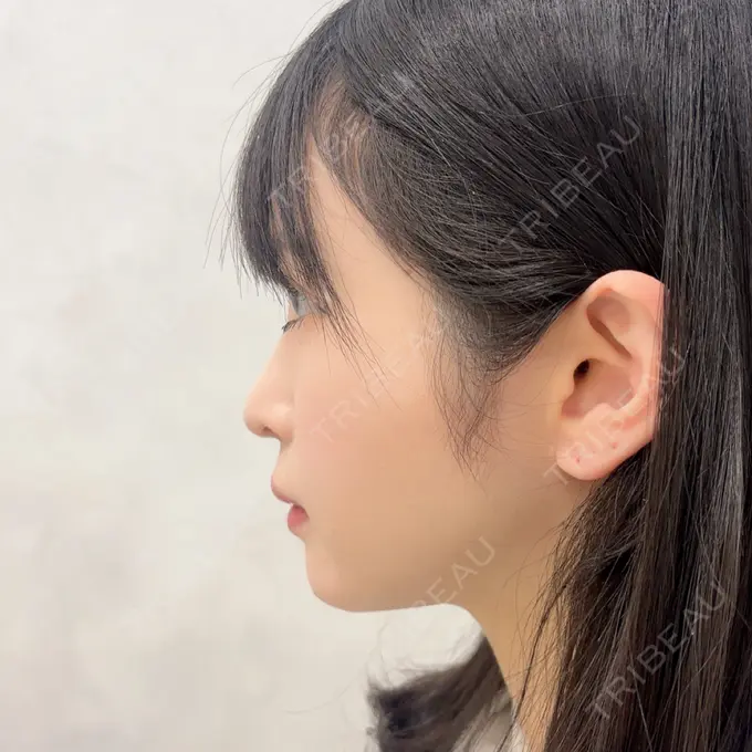 糸リフト / あごプロテーゼ / 脂肪吸引（顔） / ボトックス（エラ・小顔） WOM CLINIC GINZA （ワム クリニック ギンザ） AFTER メイン用