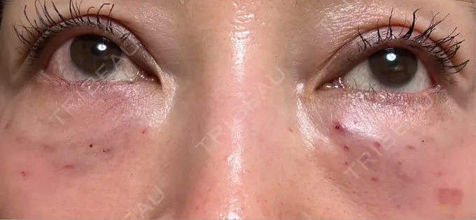 ボトックス（エラ・小顔） / 肌育注射（ジュベルックなど） / ピコスポット APスキンクリニック銀座 DAY 3 メイン用