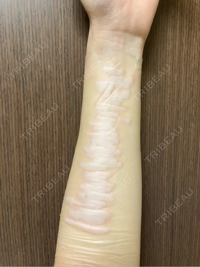 傷跡修正 きずときずあとのクリニック 銀座院 DAY 44 メイン用